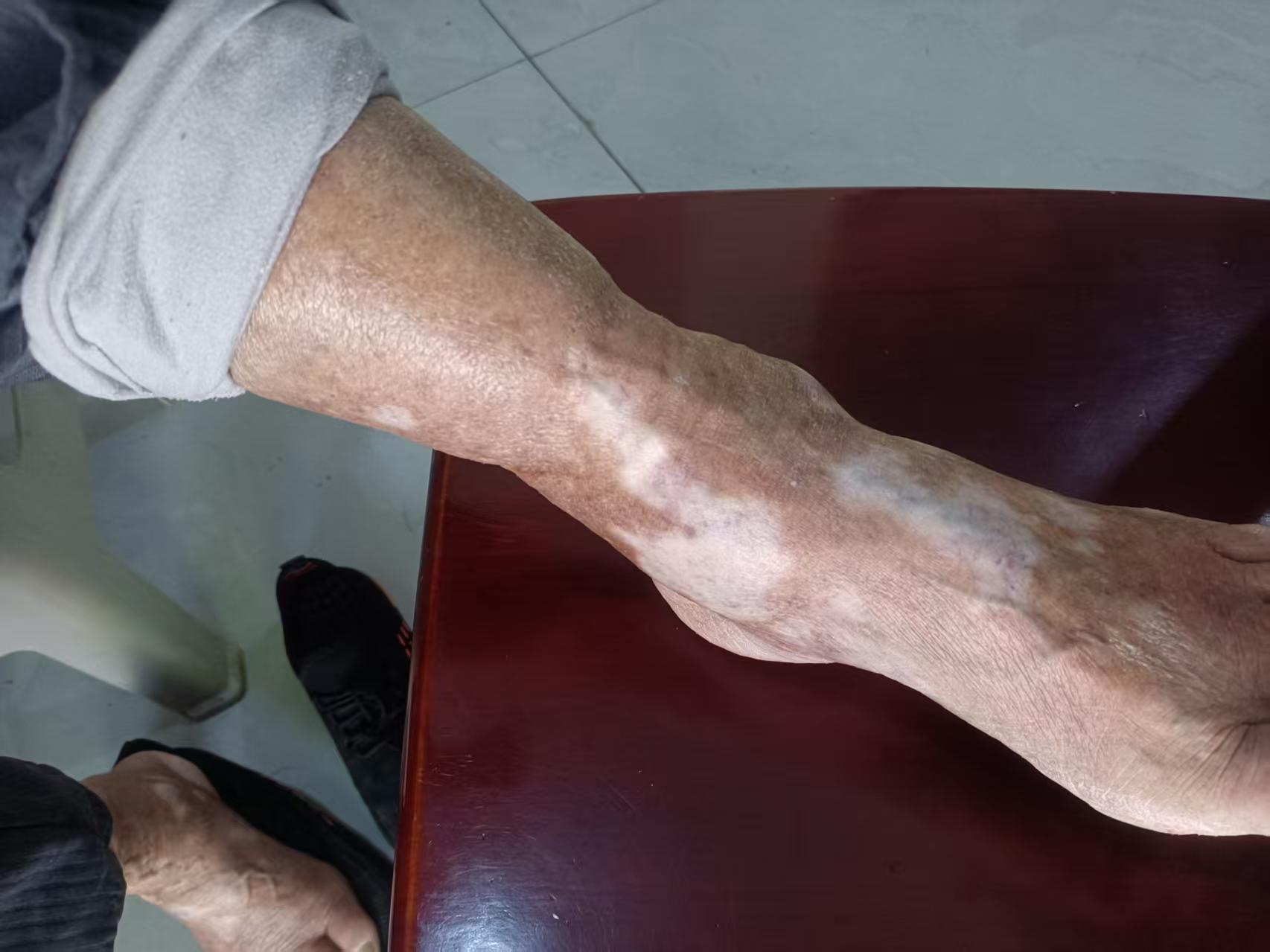 患者小腿白斑