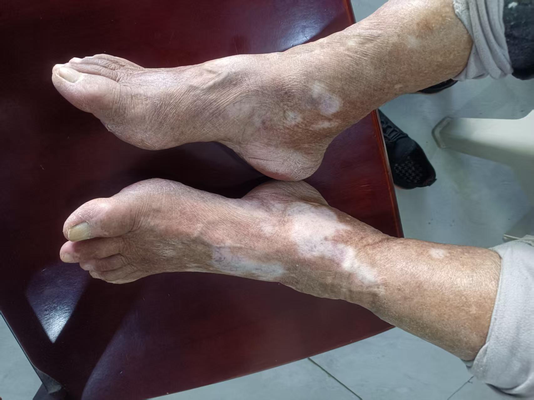 患者足部白斑